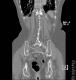 CT colon 41